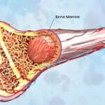 Bone marrow transplant