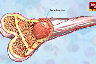 Bone marrow transplant
