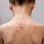 Chicken Pox