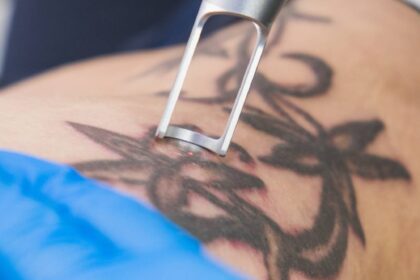 Tattoo Removing