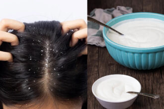 Dandruff Problem