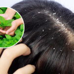 Reduce Dandruff