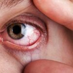 Dry Eyes