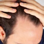 Men Hair Loss