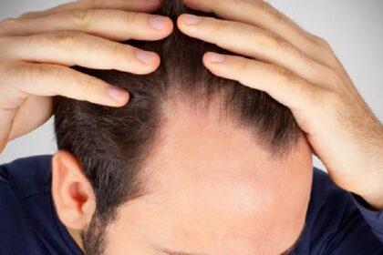 Men Hair Loss