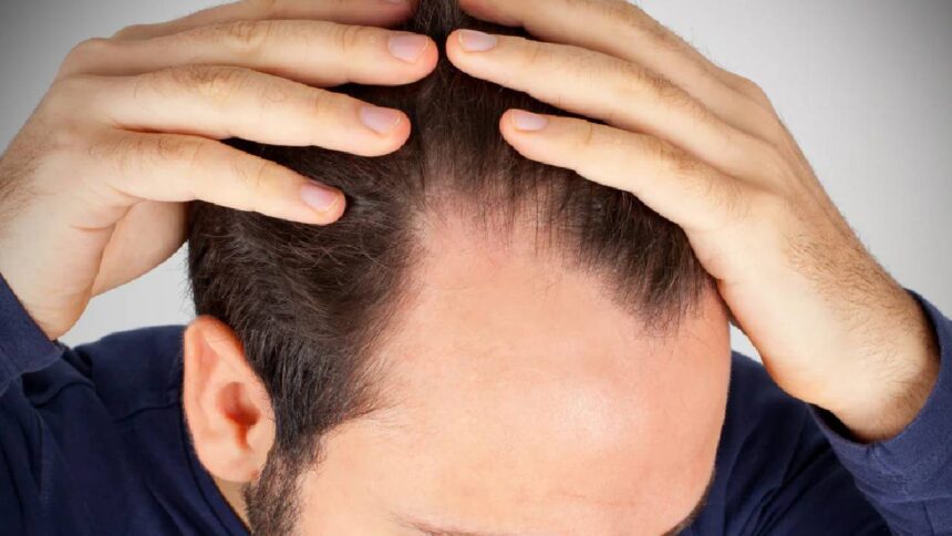Men Hair Loss