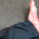 Severed Leg Mystery