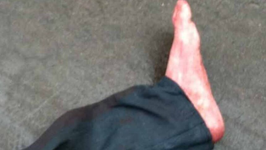 Severed Leg Mystery
