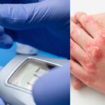 Diabetes Skin Problems