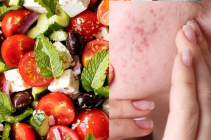 Diet to Avoid Pimple