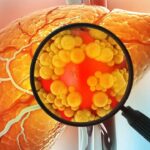 Fatty Liver