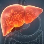 Fatty Liver