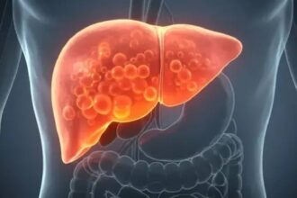Fatty Liver