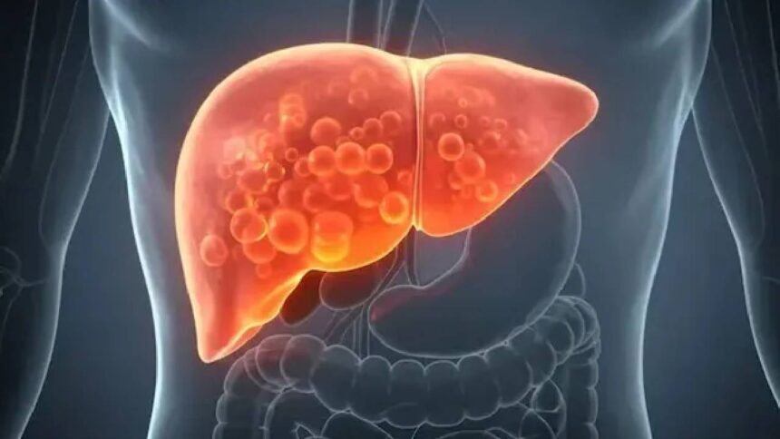 Fatty Liver